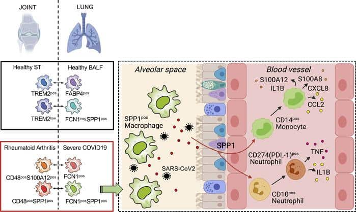 Commonalities Found Between Covid-19 & Rheumatoid Arthritis Could Help Development Of New Treatment Strategies For Long Covid