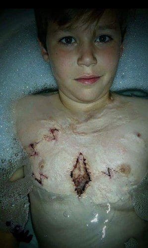 Teenager Permanently Scarred At Family Firework Display Urges People To Think Twice