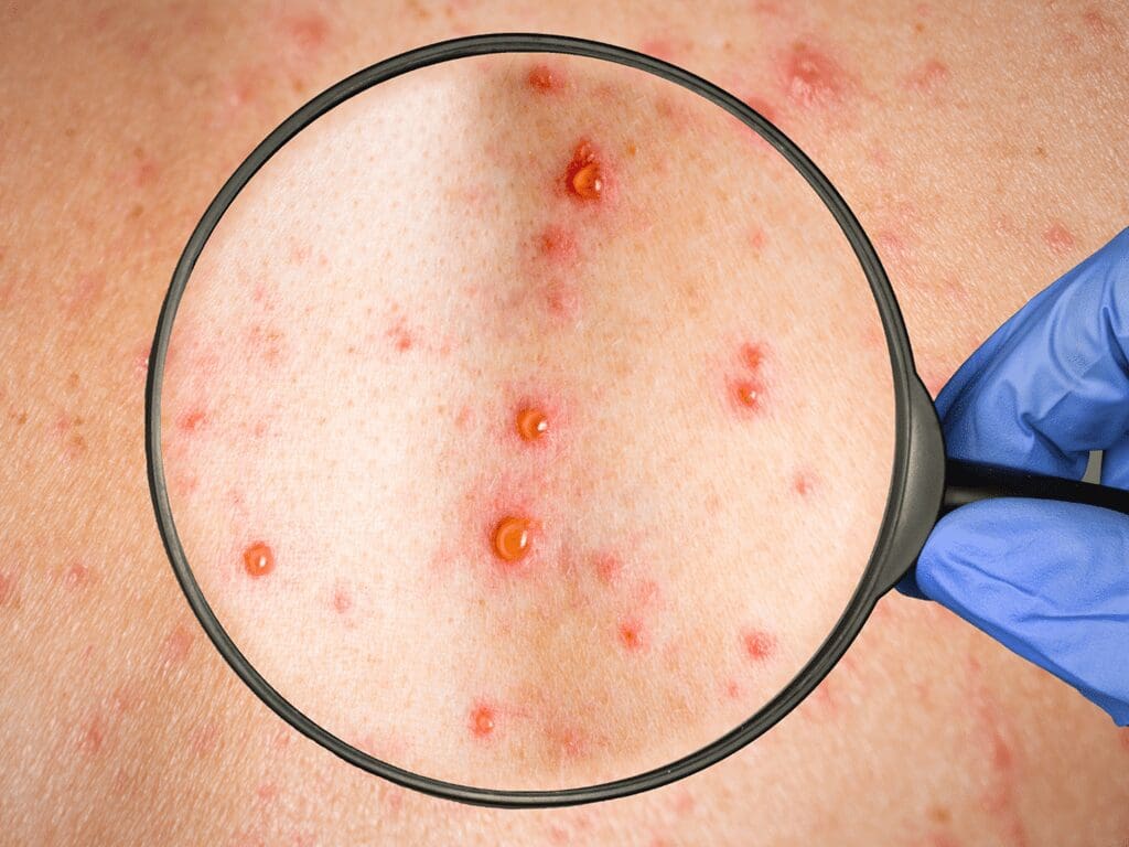 First case of monkeypox confirmed in Scotland